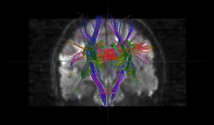 Hahn_Tractography_DWI_1.png