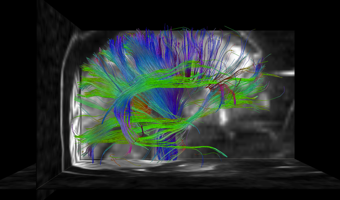 Hahn_Tractography_DWI_2.png