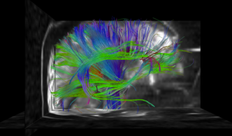 Hahn Tractography DWI 2